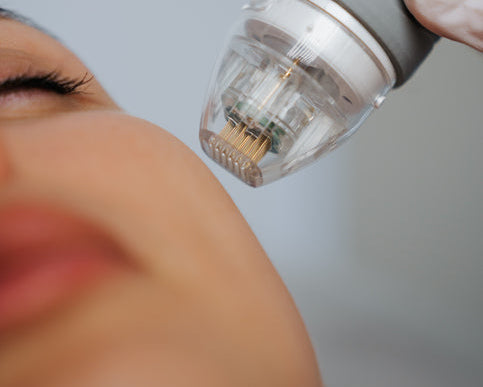 RF Skin Needling Innaloo Perth