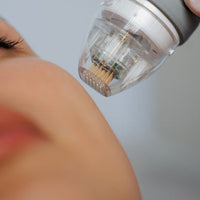 RF Skin Needling Innaloo Perth